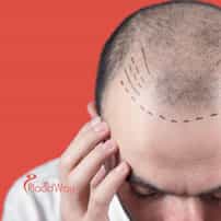 Hair Transplants in Turkey: Affordable Hair Restoration for Bahrain Men with Male Pattern Baldness